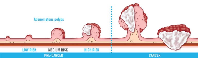 Colon Polyps: Are they cancerous? | Fight CRC