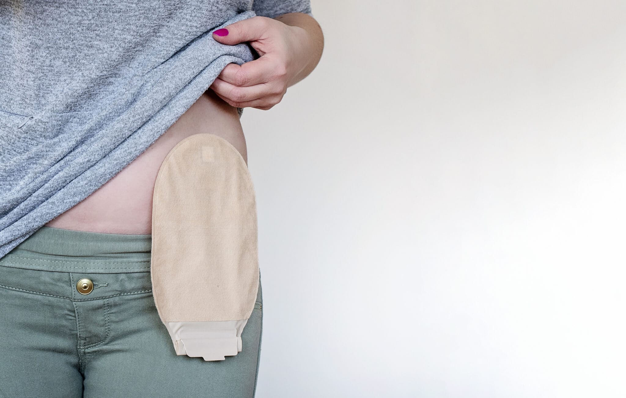 Facts About Living With an Ostomy