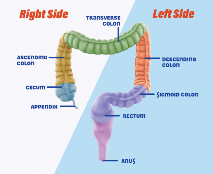 大肠癌诊断-右侧-左侧