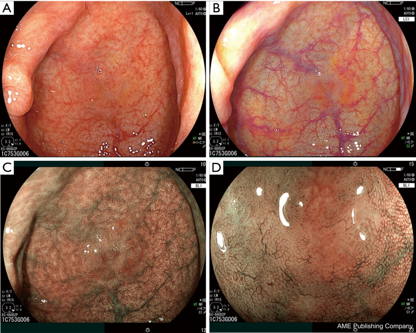 fujifilm-endoscopy-images