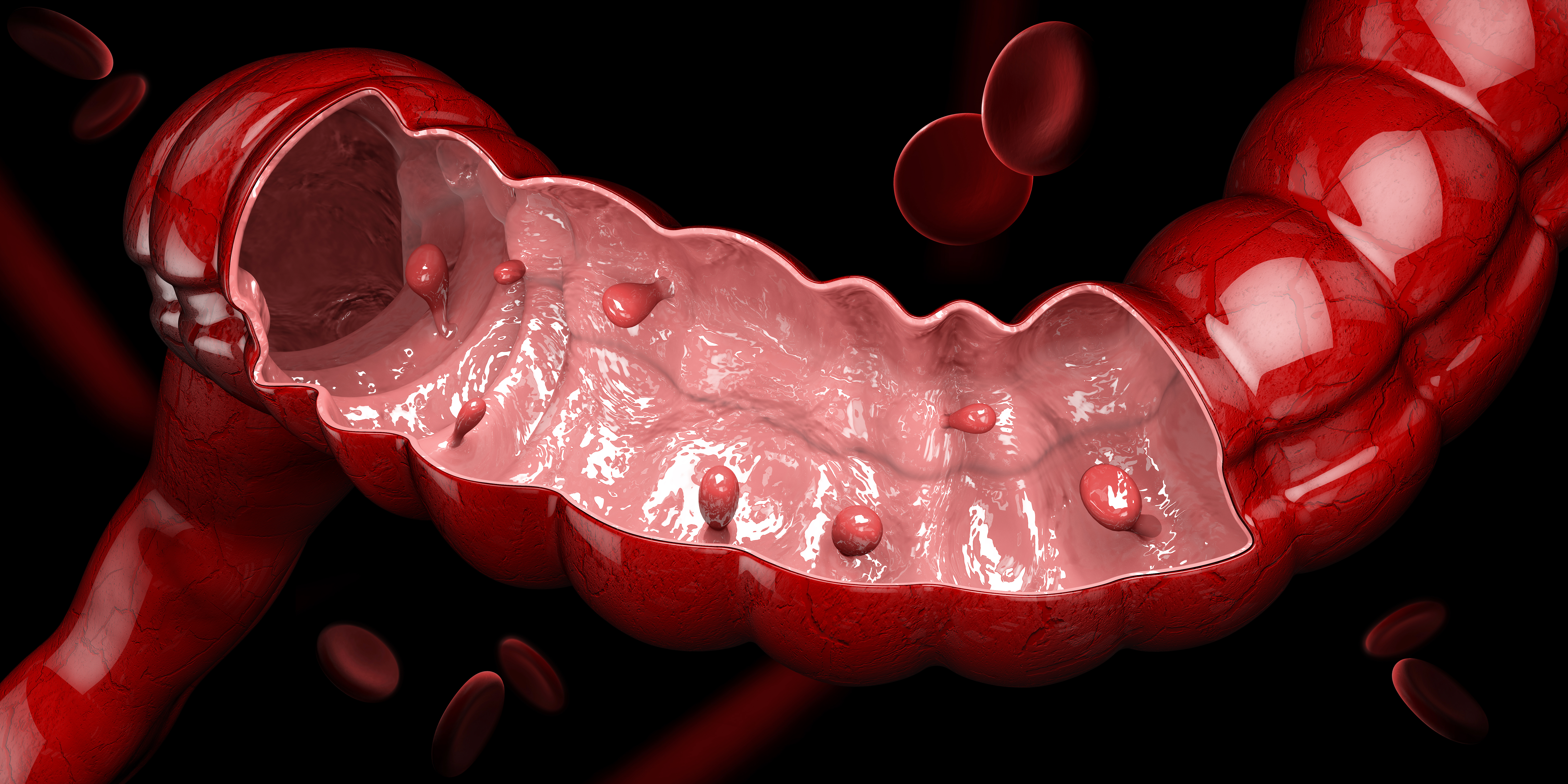How Colorectal Cancer Develops - Fight Colorectal Cancer