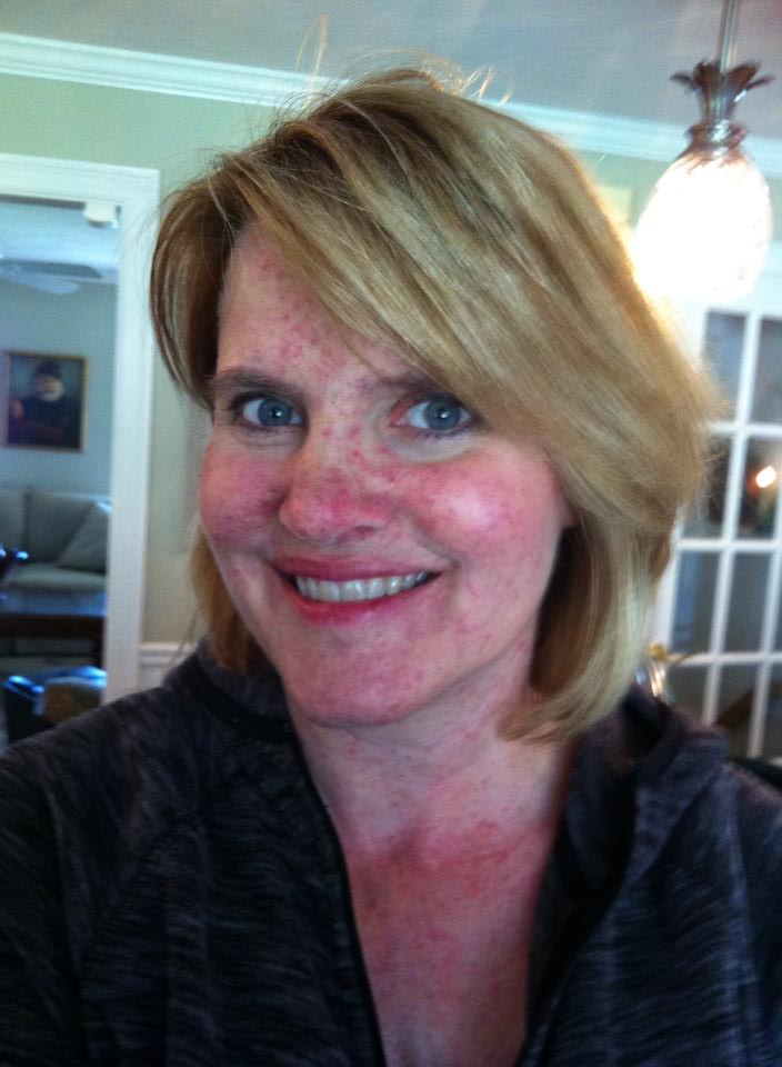 Dealing with Skin Rash and other Unpleasant Side Effects